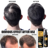 Advanced Hair Growth Treatment Kit 30ml 2ST Hair Growth Spray Hair Growth Roller och Essence Set Hair Growth Serum Anti Håravfall Advanced Hair Growth Serum Hårvård Naty Shop